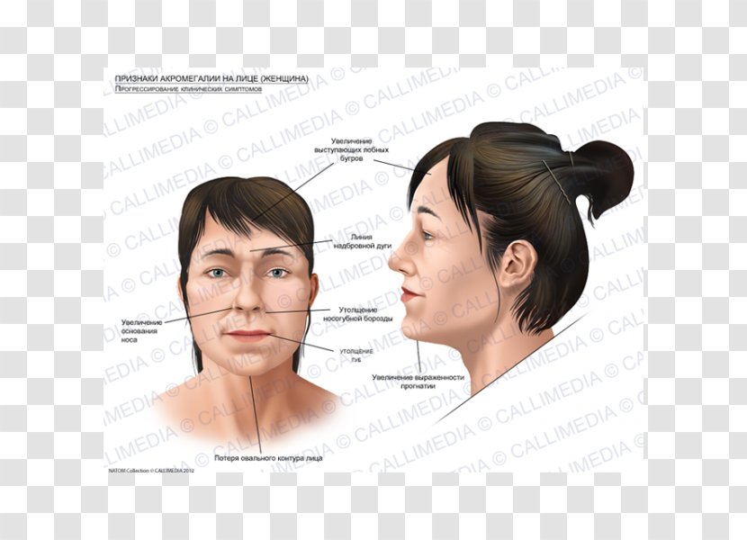 Acromegaly Face Skull Bossing Symptom Gigantism - Endocrinology Transparent PNG