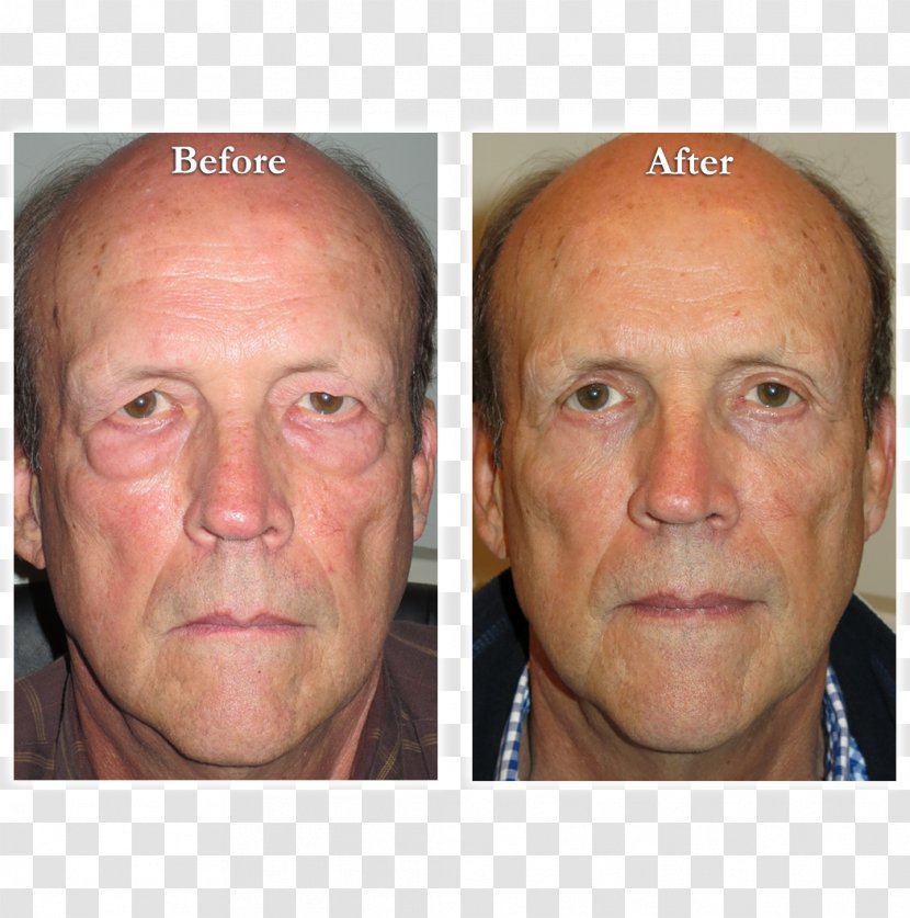 Eyebrow Blepharoplasty Eyelid Reconstructive Surgery - Mouth - Double-fold Eyelids Transparent PNG