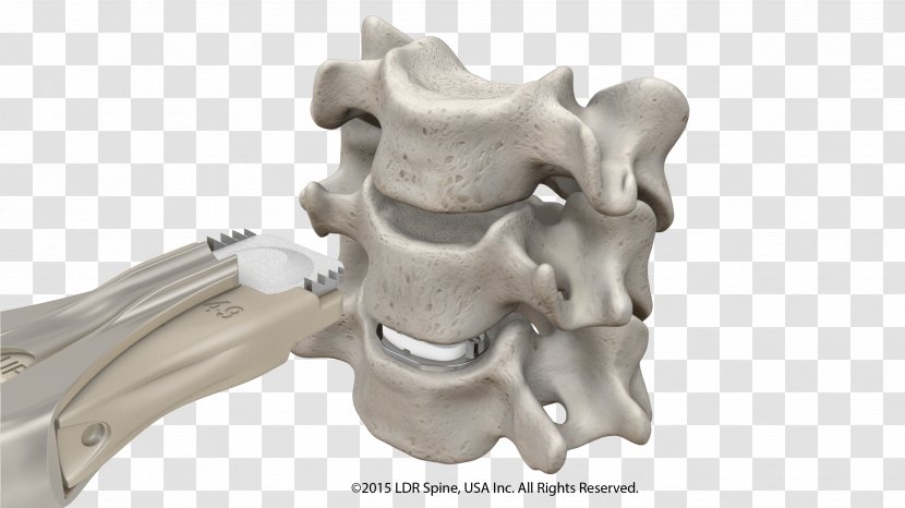 Intervertebral Disc Arthroplasty Anterior Cervical Discectomy And Fusion Spinal Implant - Jaw - Spine Transparent PNG