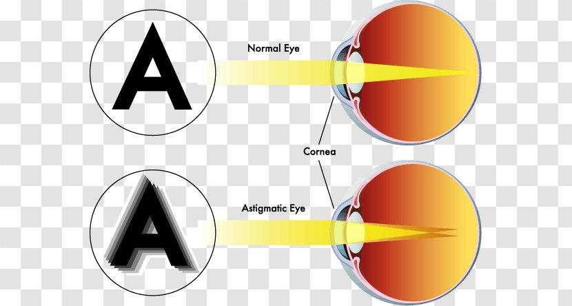 Astigmatism Near-sightedness Eye Far-sightedness Visual Perception - Lens - Headaches Transparent PNG