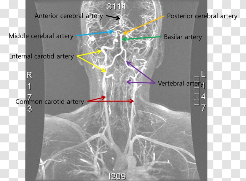 Medical Imaging Vertebral Artery Dissection Blood Vessel - Silhouette - Anterior Cerebral Transparent PNG