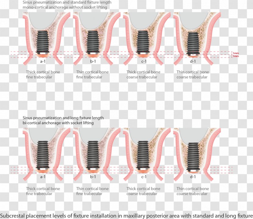 Dental Implant Maxillary Sinus Tooth Bone - Hand - Pattern Lock Transparent PNG