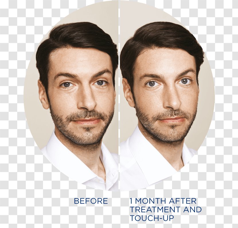 Restylane Wrinkle Beard Botulinum Toxin Dermatology - Periorbital Dark Circles Transparent PNG