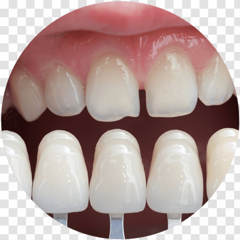 Veneer Cosmetic Dentistry Bridge - Crown Transparent PNG