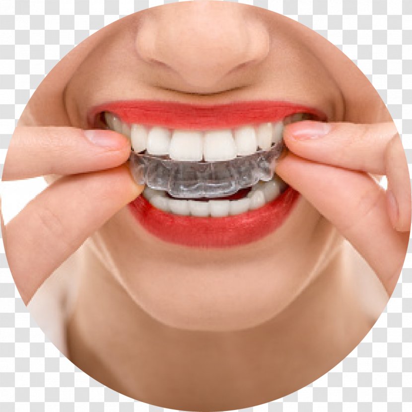 Orthodontics Dentistry Dental Braces Clear Aligners - Decayed Tooth Transparent PNG