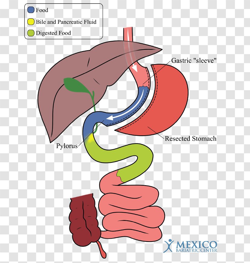 Duodenal Switch Sleeve Gastrectomy Bariatric Surgery Gastric Bypass - Flower - Vs Transparent PNG