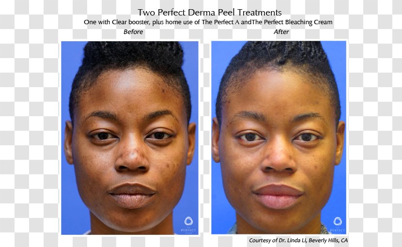 Chemical Peel Dermis Skin The Perfect Derma Face - Head - Care Model Transparent PNG