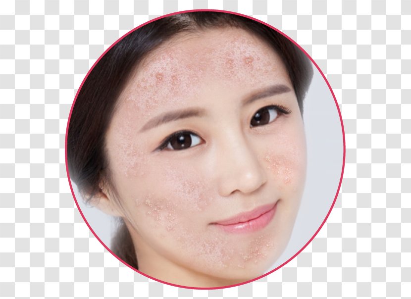 Mụn Eyebrow Acne Forehead Skin Care - Nose - Chuồn Transparent PNG
