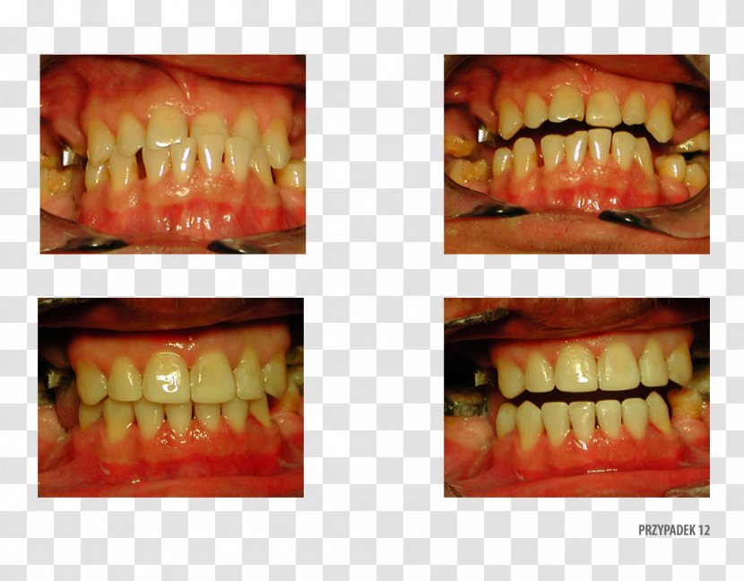 Human Tooth Gingivoplasty Gums Surgery - Frame - Silhouette Transparent PNG