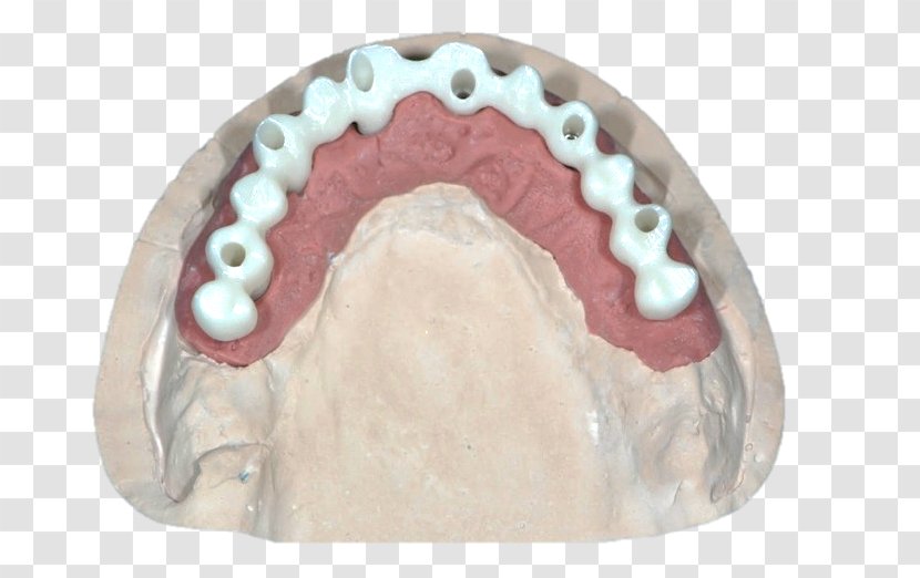 Bridge Jaw Dental Implant Diagnostic Wax-up Zirconium Dioxide - Waxup Transparent PNG