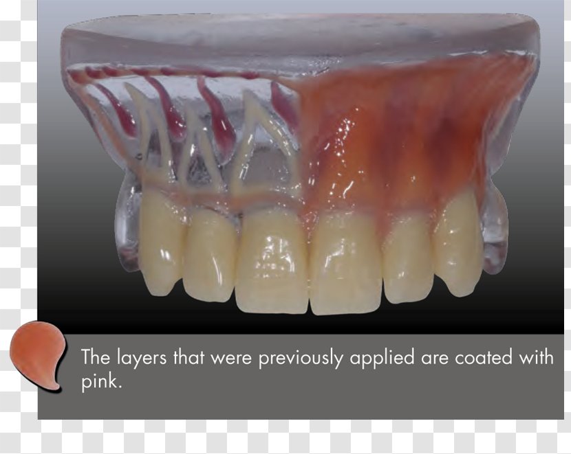 Tooth Dental Curing Light Composite Dentistry Restoration - Xpdent Corp - Aesthetic Red Transparent PNG