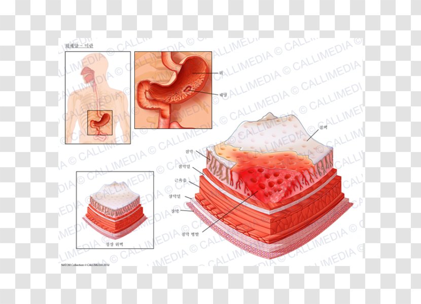 Peptic Ulcer Disease Skin Erosion Mucous Membrane Mouth - Gastric Mucosa Transparent PNG