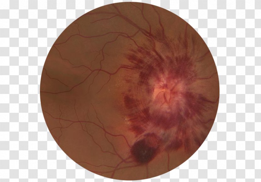 Virtual Patient Eye Ophthalmoscopy Retina Transparent PNG