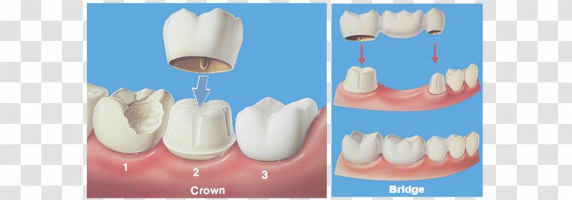 Crown Bridge Dentistry Dental Restoration - Oral Hygiene Transparent PNG