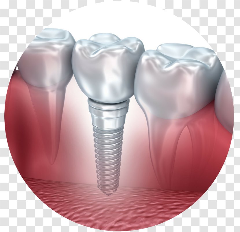 Dental Implant Dentist Tooth Surgery - Watercolor - Frame Transparent PNG