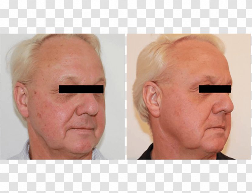 Cheek Forehead Lip Ear Nose - Energy - Skin Burn Scar Removal Cream Transparent PNG