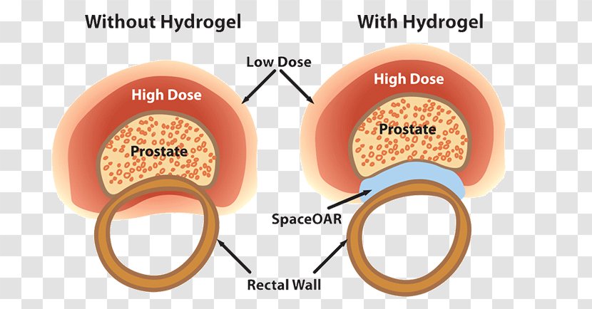 Radiation Therapy Prostate Cancer Hydrogel Treatment Of - Cartoon - Gland Transparent PNG