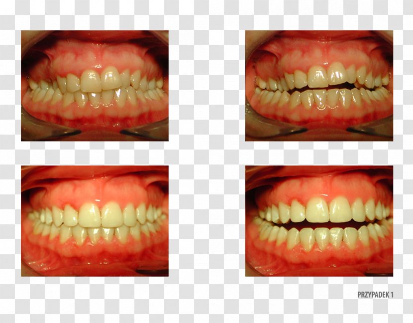 Gums Gingivoplasty Human Tooth Surgery - Plastic - Camera Transparent PNG