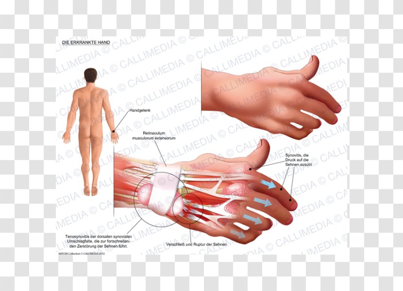 Thumb Product Design Hand Model Subcutaneous Nodules - Watercolor Transparent PNG