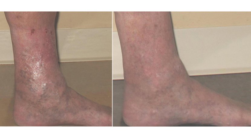 Calf Ankle Knee Neck Skin - Tree - Varicose Veins Transparent PNG