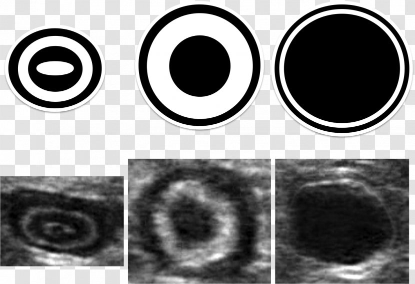Abdominal Ultrasonography Appendicitis Emergency Medicine Intestine - Heart - Una Morte Semplice Transparent PNG
