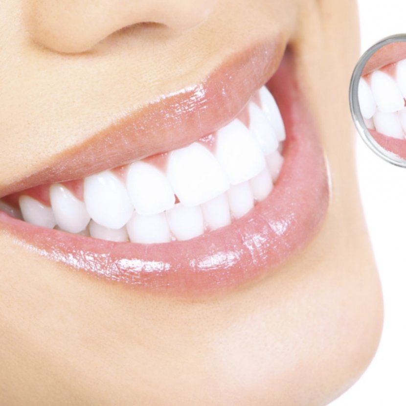 Cosmetic Dentistry Tooth Whitening Dental Surgery - Loss - Teeth Transparent PNG