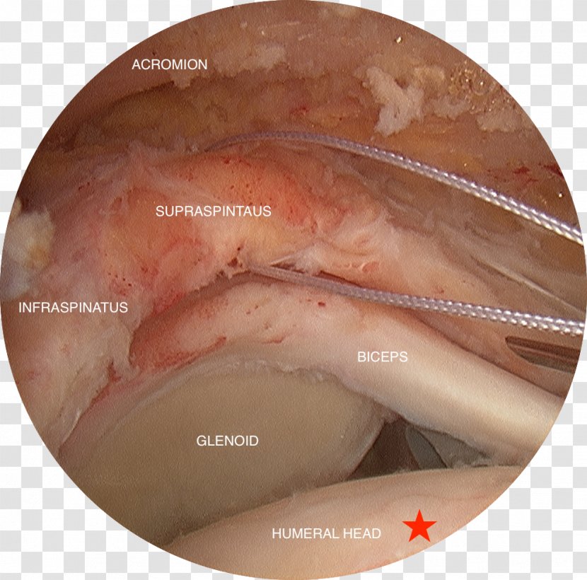 Rotator Cuff Tear Supraspinatus Muscle Arthroscopy Surgery - Flower - Infraspinatus Transparent PNG