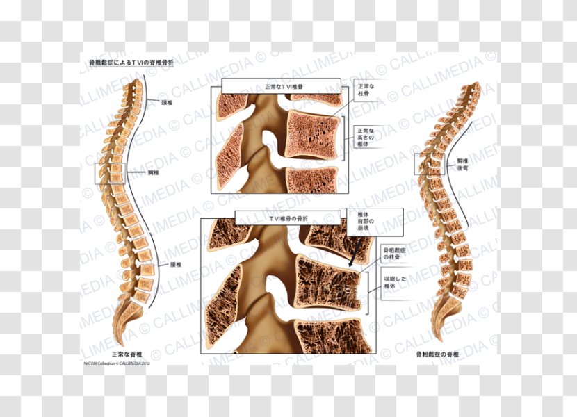 Bone Fracture Osteoporosis Vertebral Column Anatomy - Frame - Fractures Transparent PNG