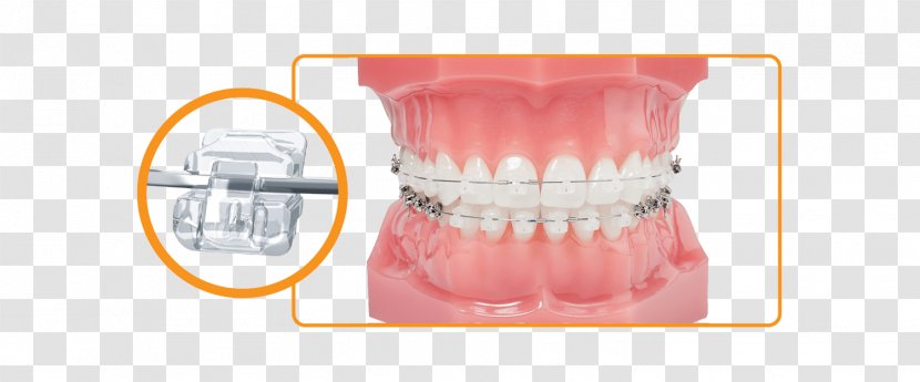 Dental Braces Damon System Orthodontics Dentistry - Dentition Transparent PNG