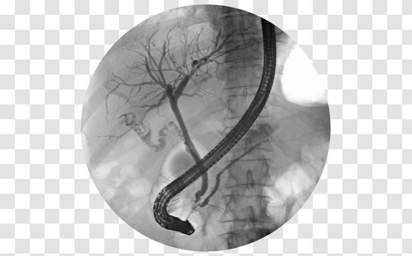 Endoscopic Retrograde Cholangiopancreatography Bile Duct Endoscopy Gallstone - Common Stone - Organism Transparent PNG