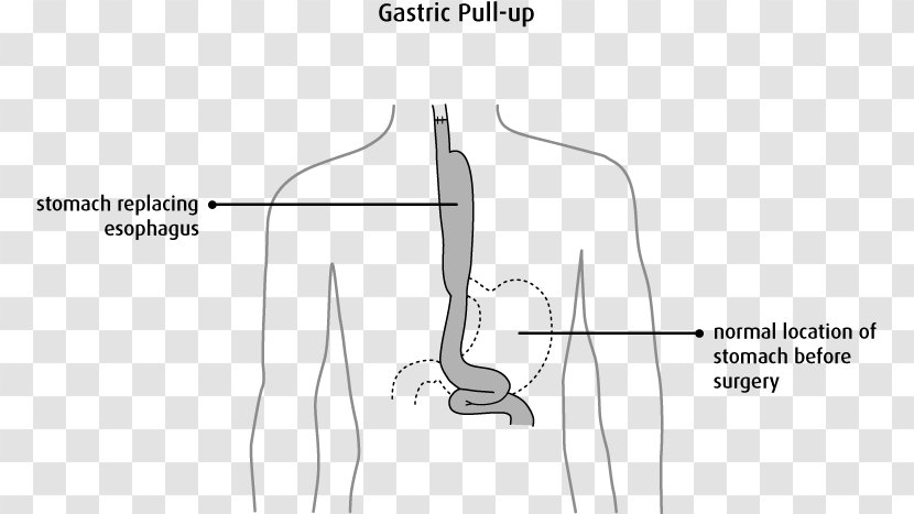 Thumb Surgery /m/02csf Esophageal Cancer Esophagus - Heart - Gastroesophageal Reflux Disease Transparent PNG