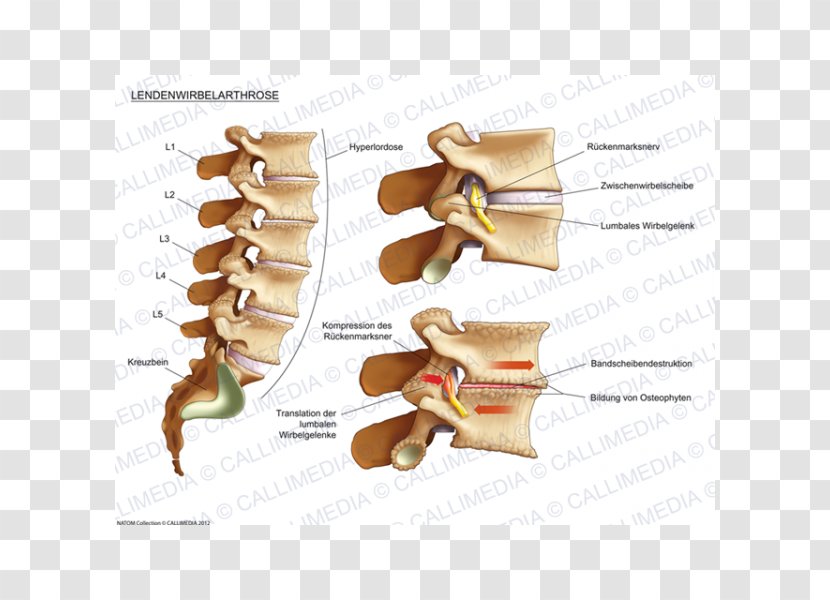 Joint Osteoarthritis Lumbar Vertebrae Process Human Back - Artrosis De Rodilla Transparent PNG