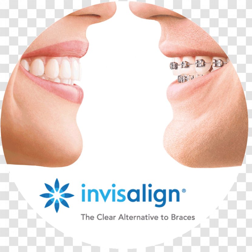 Clear Aligners Dental Braces Orthodontics Dentistry Retainer - Nose - Invisalign Transparent PNG
