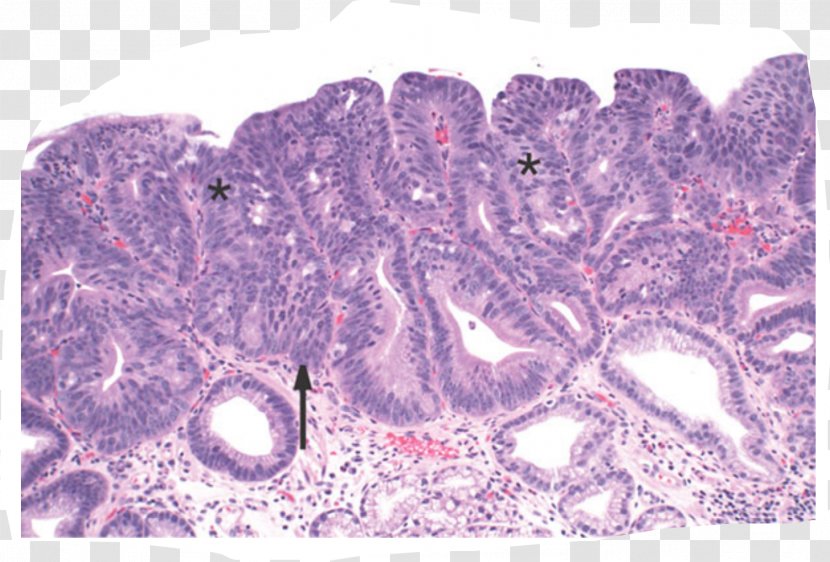 Barrett's Esophagus Intestinal Metaplasia Epithelium Adenocarcinoma - Grading - Magenta Transparent PNG