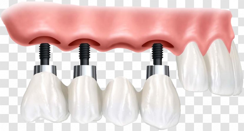 Dental Implant Dentistry Dentures Tooth Loss - Surgery Transparent PNG