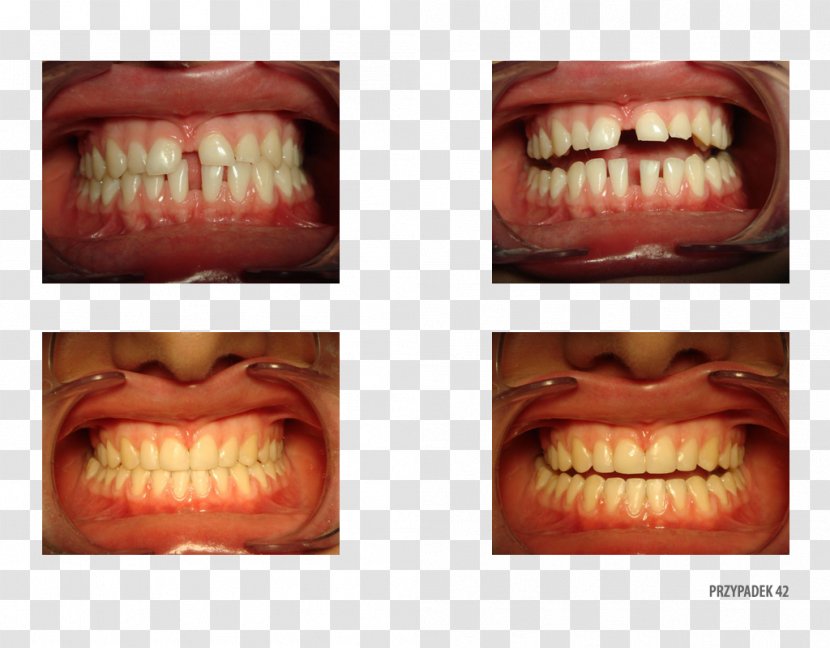 Tooth Close-up Therapy Patient .pl - Lip - Close Up Transparent PNG