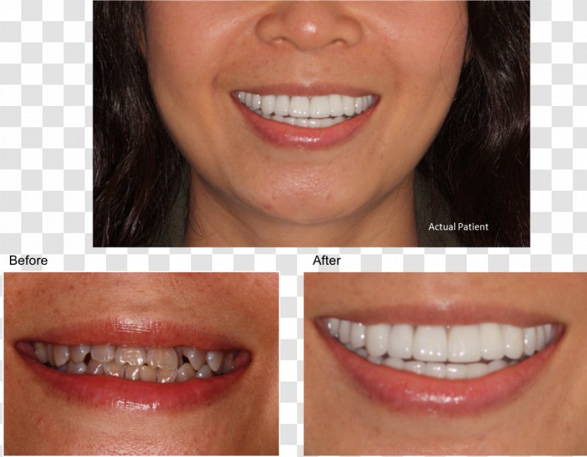 Cosmetic Dentistry Tooth Discoloration Tetracycline Antibiotics - Cheek - Ipl Transparent PNG