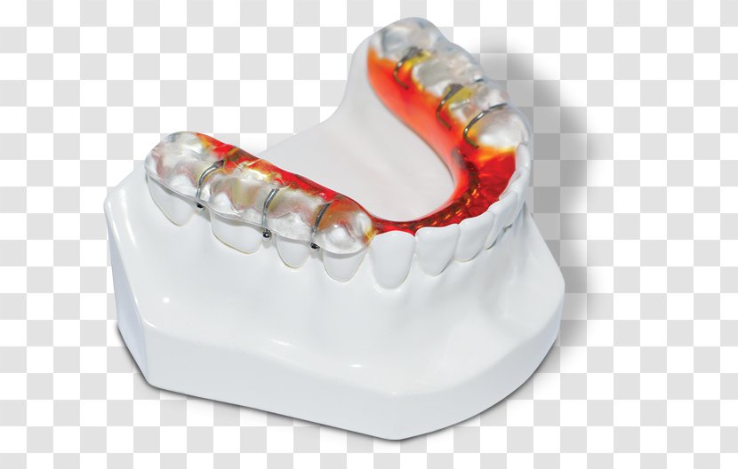 Mandible Jaw Tooth Maxilla Dentistry - Home Appliance - Mandibular Advancement Splints Transparent PNG