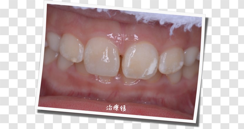 Tooth Gums Dental Braces Mouthguards Dentition - Postcard Transparent PNG