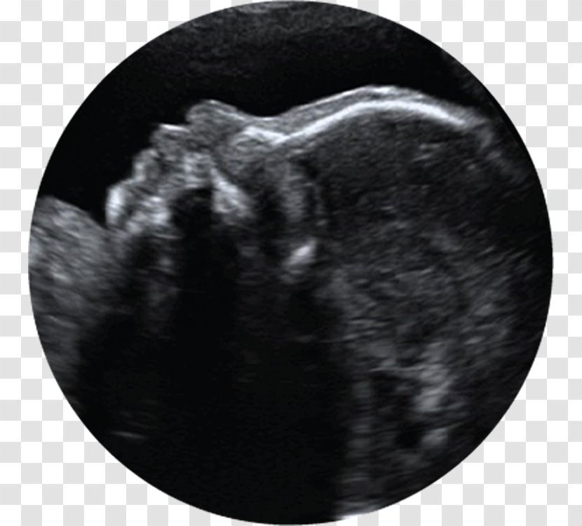 3D Ultrasound Ultrasonography Pregnancy Infant - Childbirth - Babyultrasound Transparent PNG