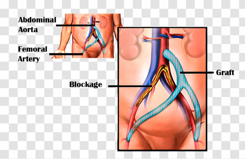 Vascular Bypass Coronary Artery Surgery Femoral Aorta Peripheral Disease - Cartoon - AIDS Transparent PNG