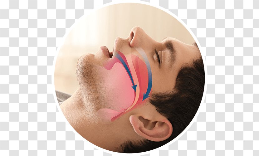 Obstructive Sleep Apnea Snoring Mandibular Advancement Splint Dentist - Forehead - Disorder Transparent PNG