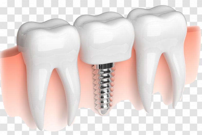 Dental Implant Dentistry Dentures Bridge - Heart - Dissolve Transparent PNG