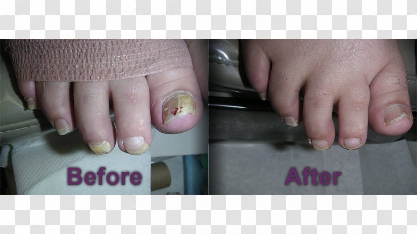 Nail Podiatry Foot Onychomycosis Medicine - Care Transparent PNG