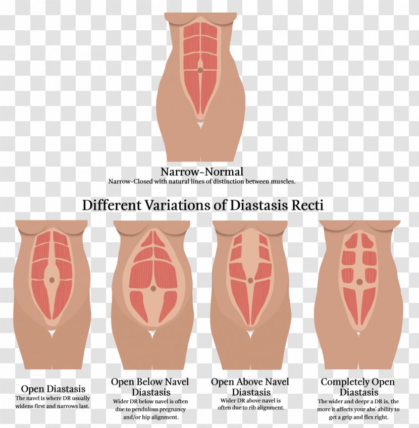 Diastasis Recti Rectus Abdominis Muscle Abdomen Physical Therapy - Flower - Text Plate Transparent PNG