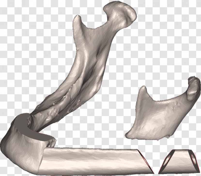 Fibula Surgery Mandible Osteotomy Bone - Mandibular Advancement Splints Transparent PNG