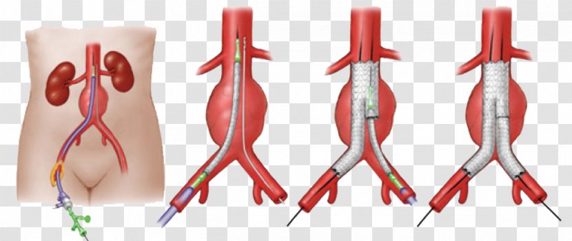 Abdominal Aortic Aneurysm Endovascular Repair Vascular Surgery - Medicine - Heart Transparent PNG