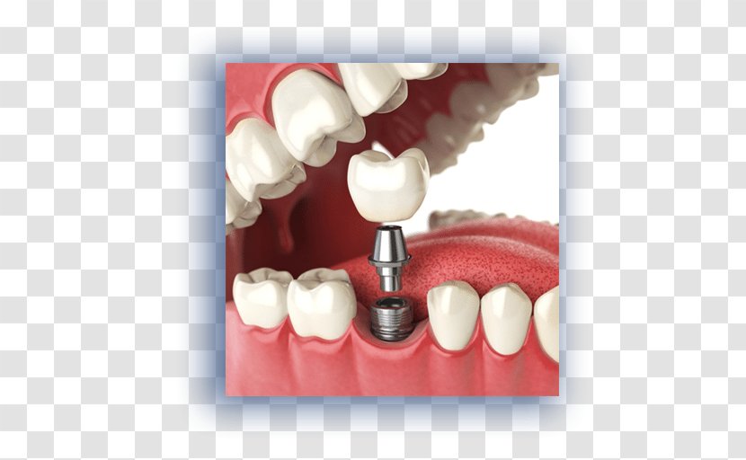 Dental Implant Dentistry Tooth Loss - Frame Transparent PNG
