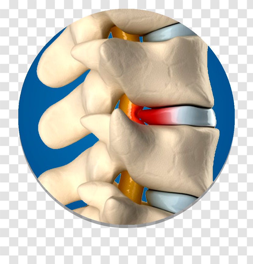 Spinal Disc Herniation Vertebral Column Surgery Intervertebral - Jaw - Epidural Steroid Injection Transparent PNG