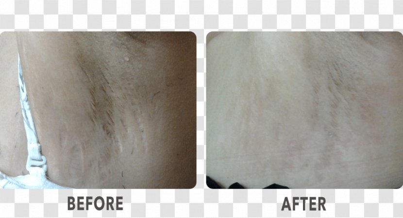 La Skinnovita- Dr. Anuj Pall Dermatology, Laser & Hair Centre Wood Material Scar - Radio Frequency Transparent PNG